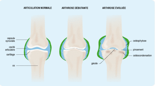 Santé senior - Arthrose du genou: l'évolution de l'arthrose Arthrose du genou: l'évolution de l'arthrose